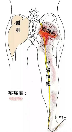 梨狀肌