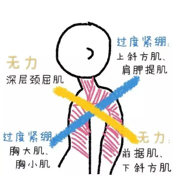 上交叉綜合征