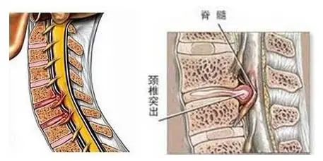 頸椎突出