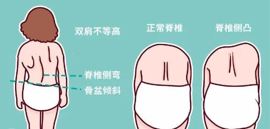 脊柱側(cè)彎