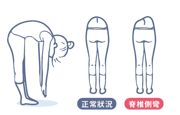 脊柱側(cè)彎自測(cè)