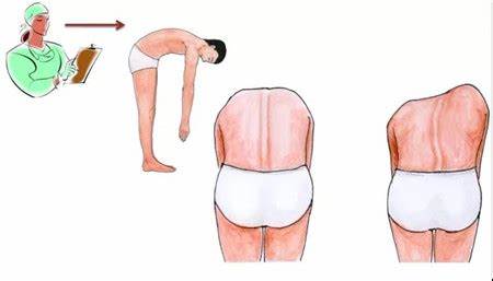 脊柱側(cè)彎自測(cè)