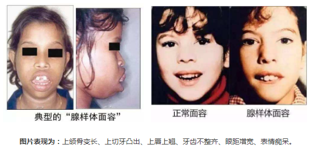 正常面容與腺樣體面容圖片對比圖