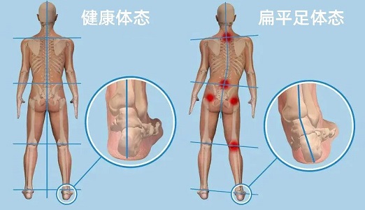 扁平足體態(tài)和健康體態(tài)對比圖