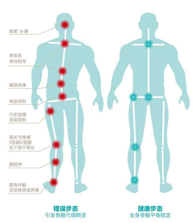 錯誤步態骨骼代償畸變