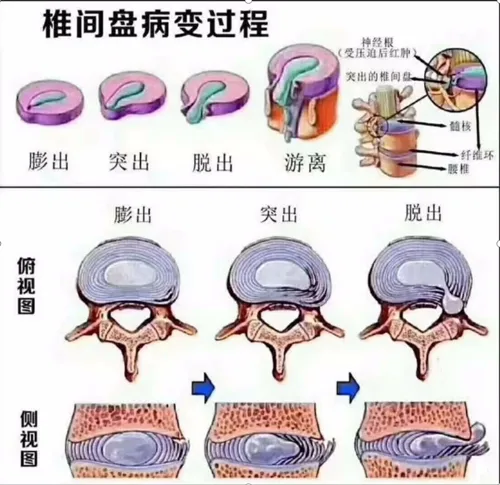 椎間盤病變過(guò)程