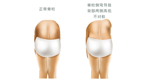 脊柱側(cè)彎對比圖