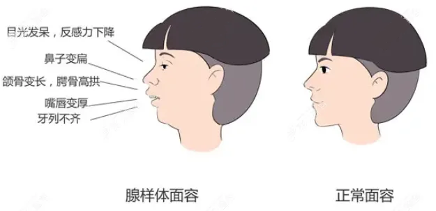 腺樣體面容
